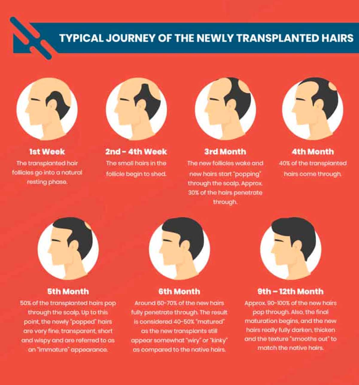 What Should I Do After Hair Transplant?